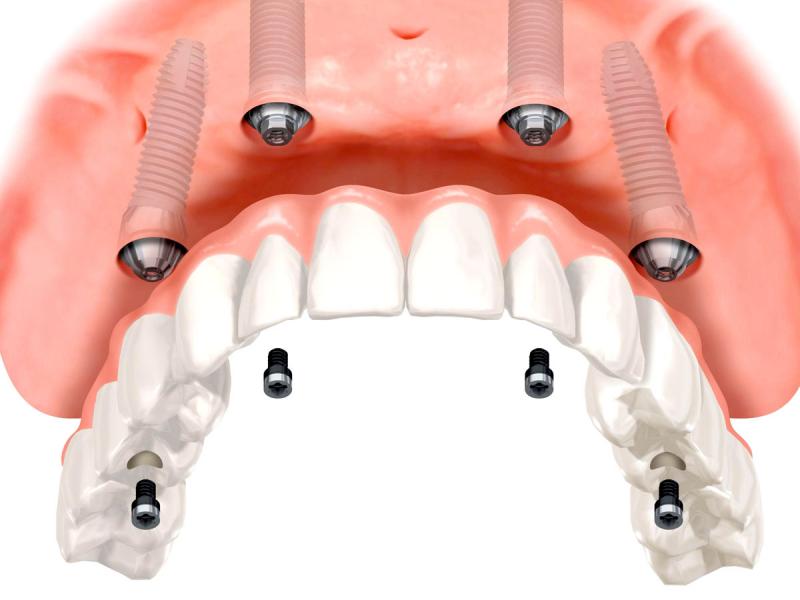 Импланты зубов 